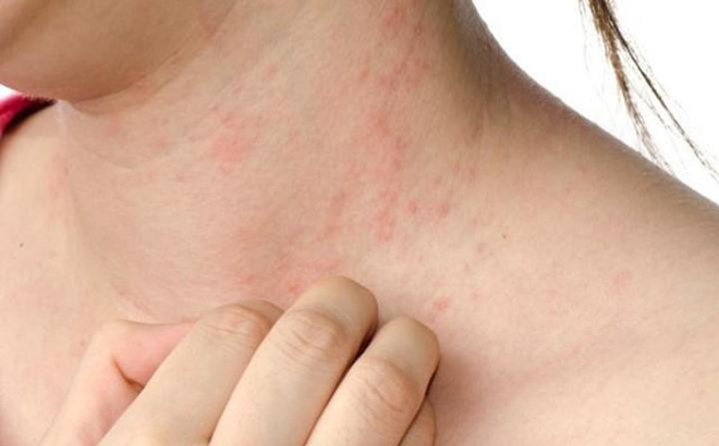 Thời tiết thay đổi đề phòng viêm da dị ứng